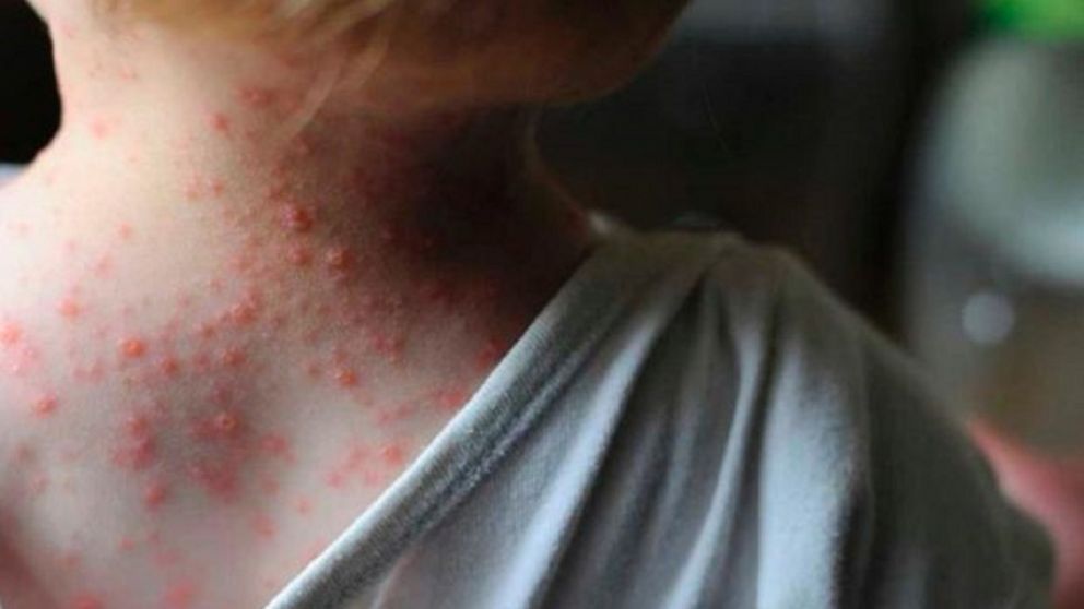 La Mpox se manifiesta a través de lesiones en la piel o mucosas.