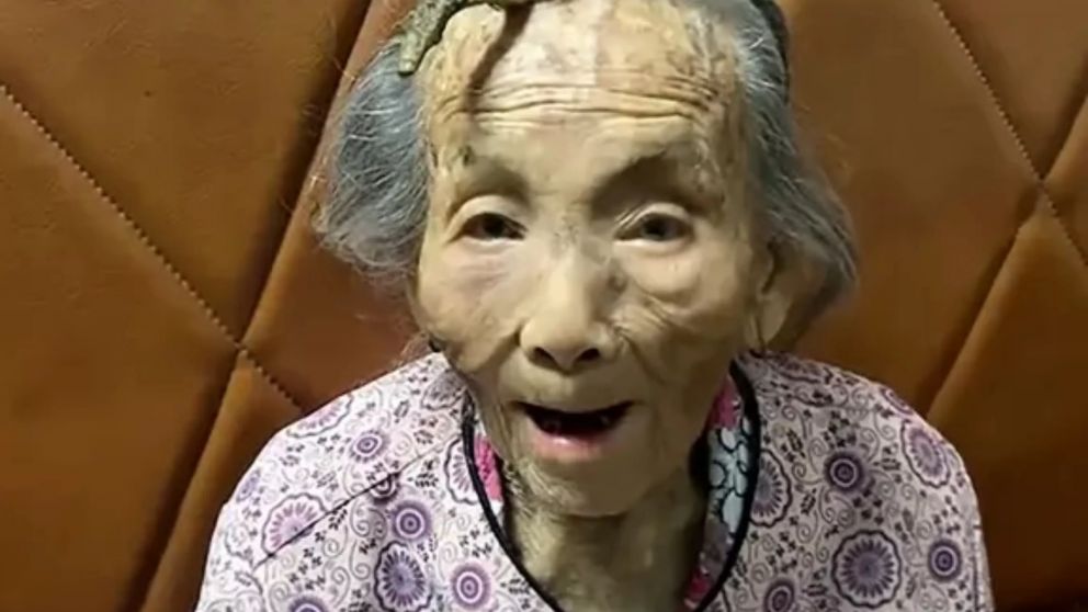 La mujer longeva rechaz� la idea de remover la protuberancia.