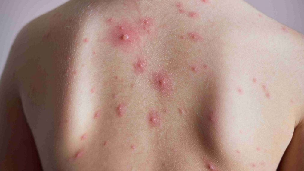 Hasta el momento, el continente contabiliza unos 4.500 casos de viruela del mono, considerada endémica en unos diez países africanos.
