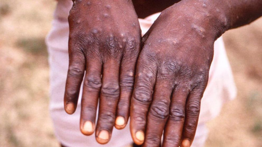 Confirmaron el primer caso de la viruela simica en Mendoza.