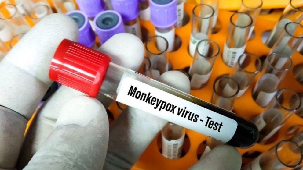 La OMS advirtió el riesgo global de la viruela del mono puede aumentar si "el virus logra establecerse en países no endémico" (Imagen ilustrativa).
