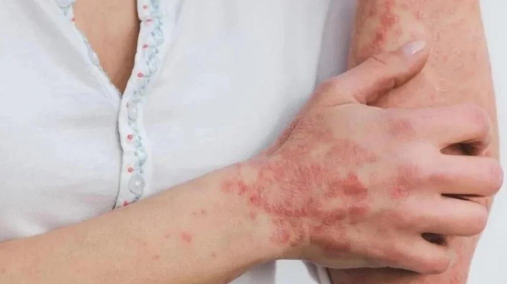 Viruela del mono: confirmaron en Francia 16 casos.