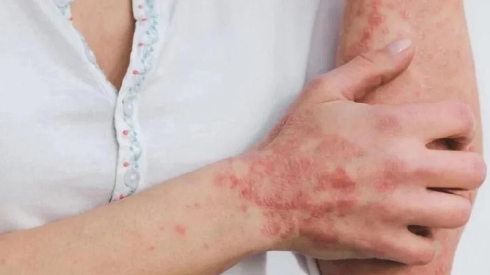 Viruela del mono: confirmaron en Francia 16 casos.