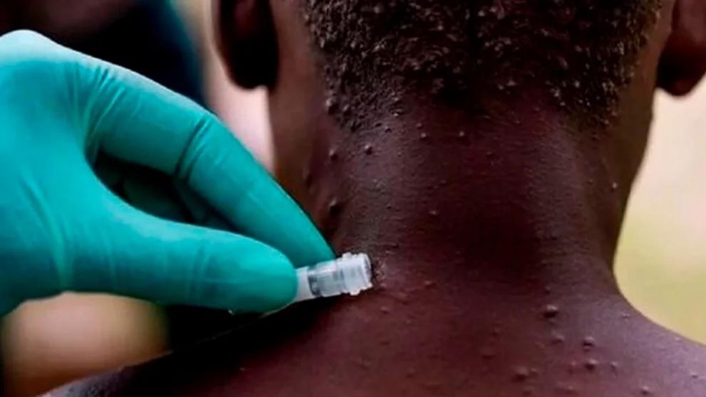 Los investigadores observaron las respuestas de pacientes con viruela del mono a a dos antivirales diferentes.