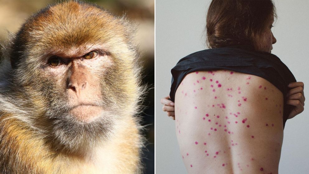 Desde la OMS dicen que el virus de la viruela del mono es similar a la viruela humana y, aunque es mucho m�s leve, puede ser mortal
