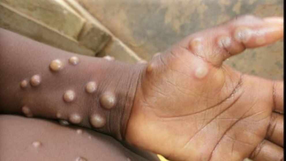 Alerta, ¿la viruela del mono llegó a Argentina?