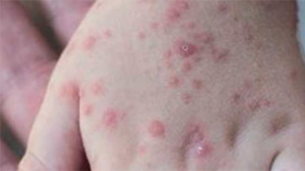 La erupci�n cut�nea, uno de los s�ntomas de esta enfermedad que est� en proceso de expansi�n.