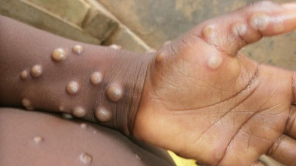 Además, Italia reportó una nueva "cepa" en África Occidental, aunque se trata de una más amigable para el ser humano.