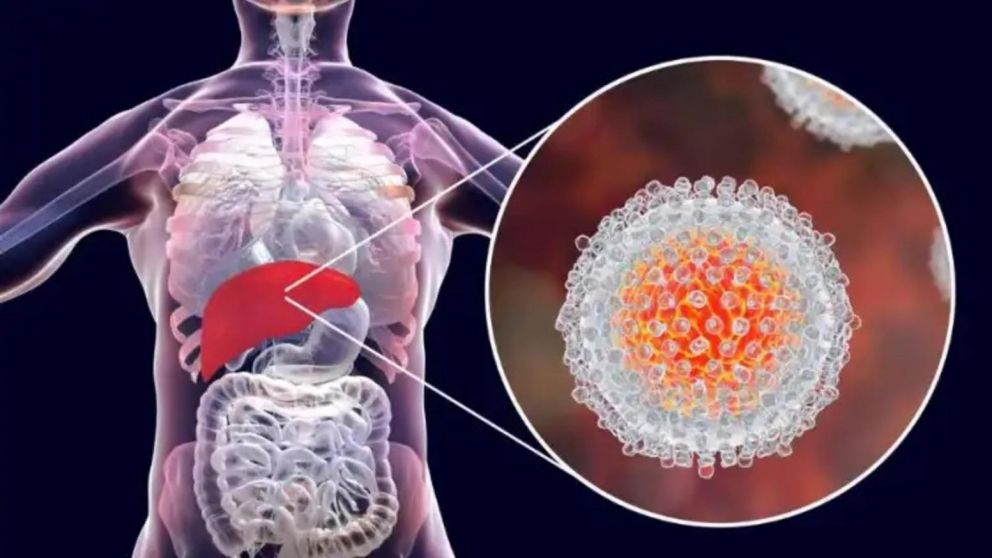 Especialistas aseguran que ya son 300 en el mundo los casos de hepatitis infantil de origen desconocido.