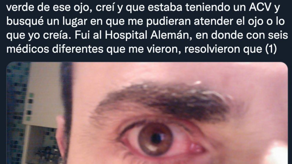 El hombre contó lo que le había sucedido en su ojo para concientizar sobre este problema de la visión.