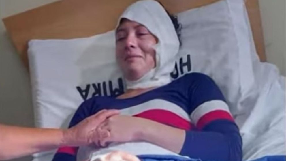 Priscila Metz de 25 años fue atacada por su expareja quien le arrojó aceite hirviendo.