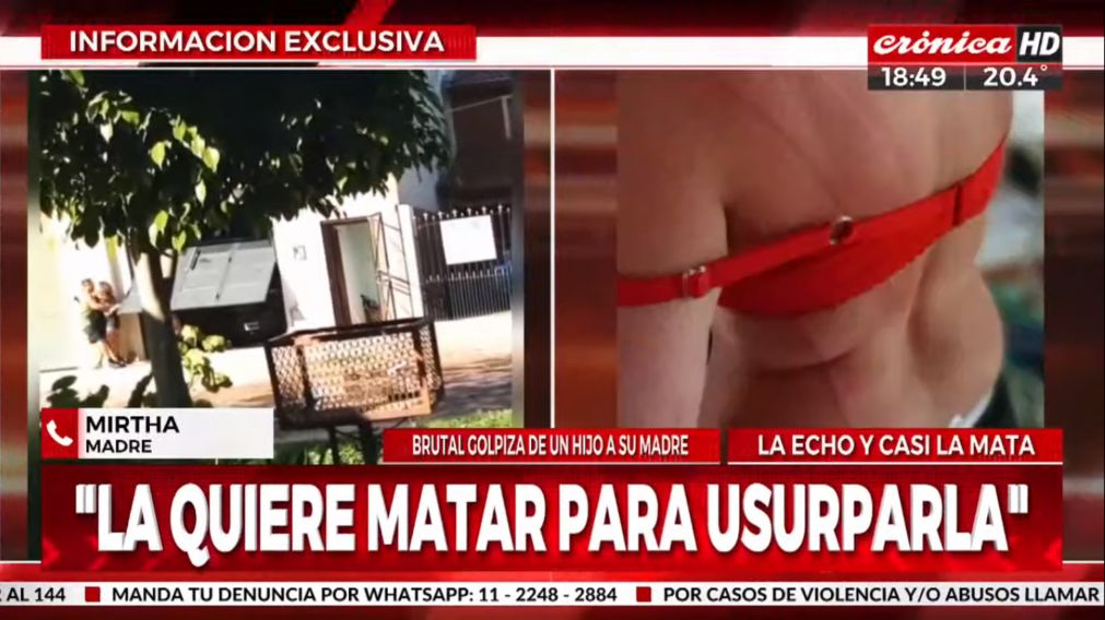 La espalda de Mirta da muestra de la violencia de su hijo (Crónica HD).
