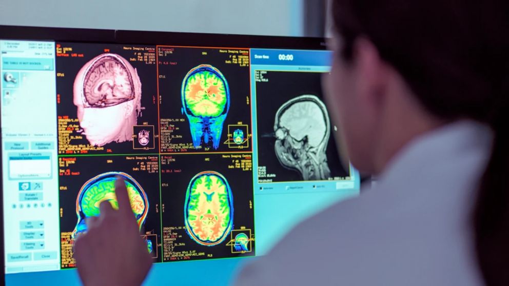 Covid: ¿Cuáles son los principales daños cerebrales que pueden sufrir quienes se recuperaron? (imagen ilustrativa).