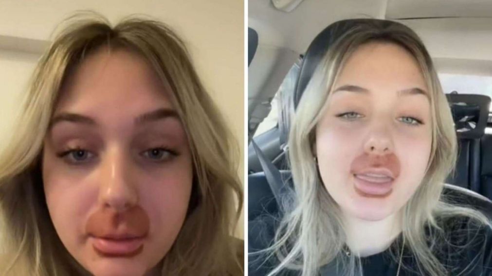 Una joven se hizo un tratamiento en los labios y ahora es comparada con Homero Simpson (imagen TikTok).