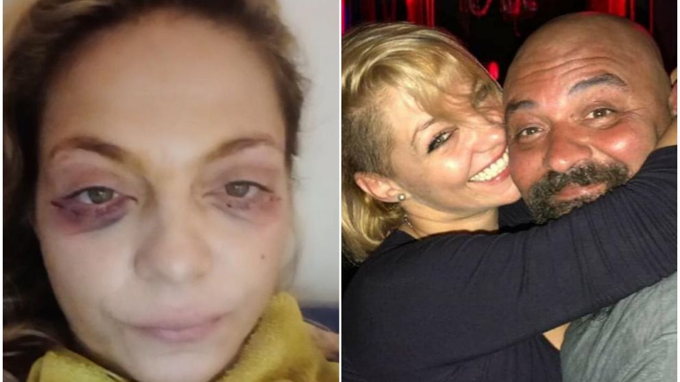 Con dos grandes moretones en los ojos, la actriz apareció en un video por Instagram para dar explicaciones.