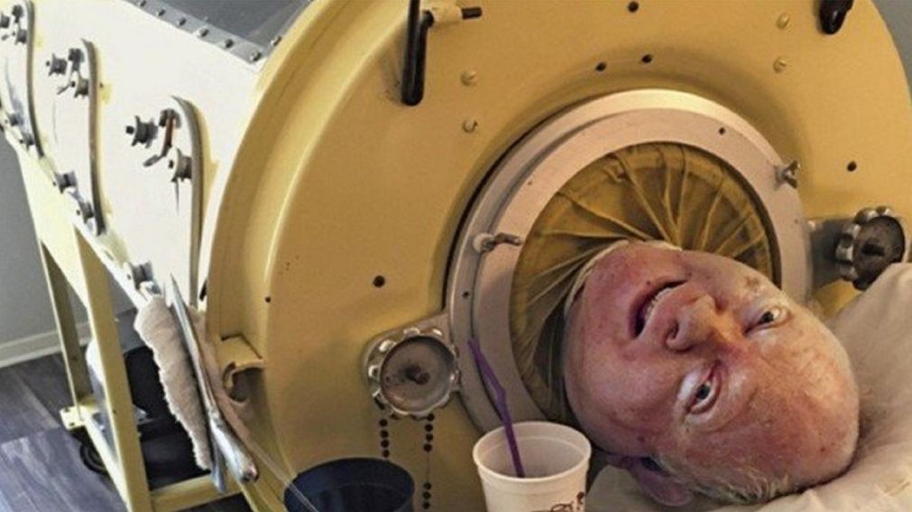 La historia de "Polio Paul", el hombre que vive atado a un pulmón de acero y que no se mueve hace 70 años.