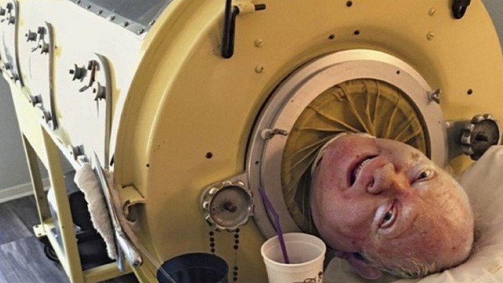 La historia de "Polio Paul", el hombre que vive atado a un pulmón de acero y que no se mueve hace 70 años.