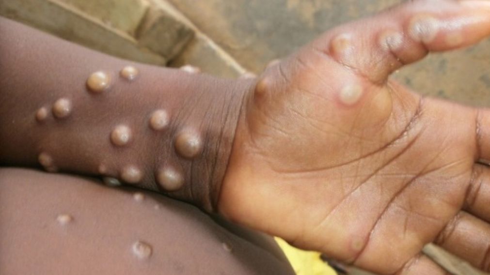 La viruela de mono ya había causado un brote entre humanos en los Estados Unidos.