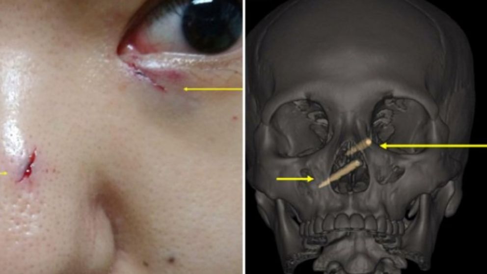 Tuvo que ser sometida a intervención quirúrgica para poder retirar los palillos de su cráneo.