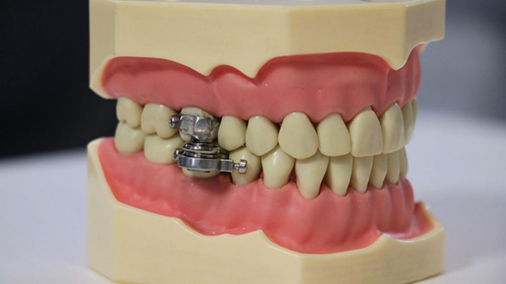 El DentalSlim Diet Control impide que el usuario abra la boca más de dos milímetros, por lo que tendría que llevar una dieta líquida (Twitter).