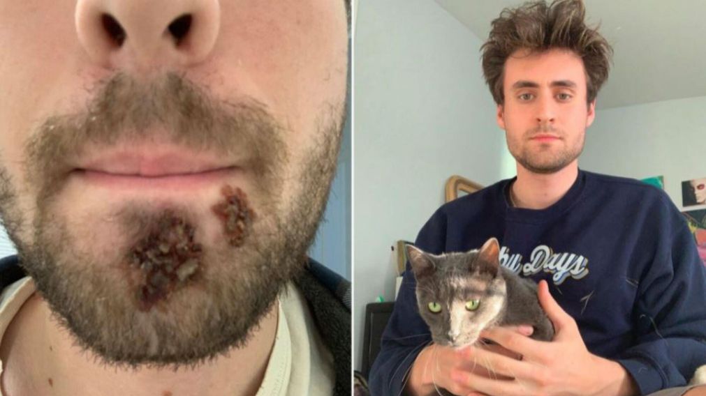 El antes y después de Nick Holterman, atacado por la bacteria come carne (Nypost)