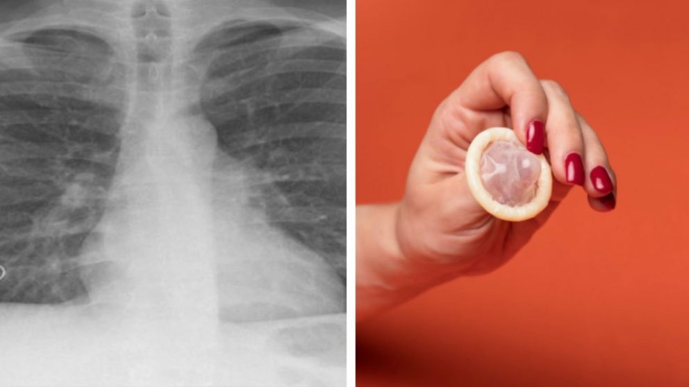 El origen de la lesión en los pulmones de la mujer era el preservativo.