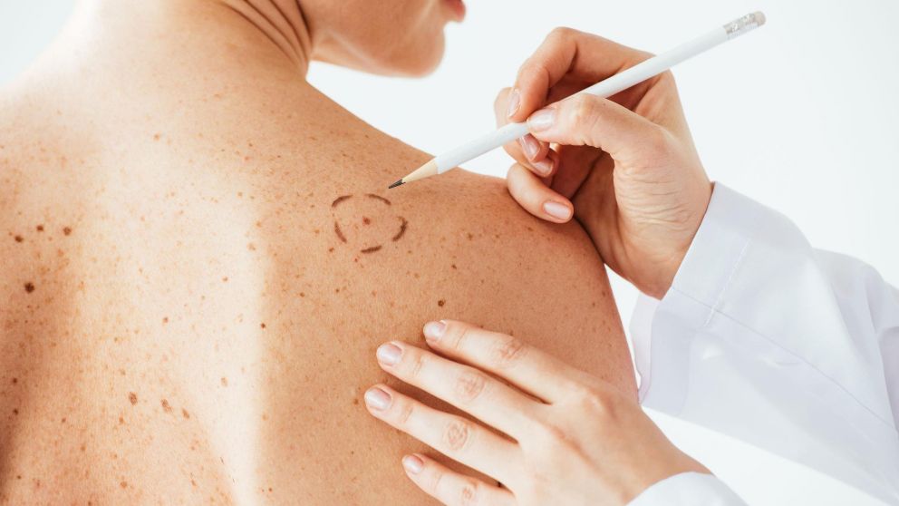 El chequeo de lunares ayuda a la prevención de este tipo de cáncer de piel (Imagen ilustrativa)