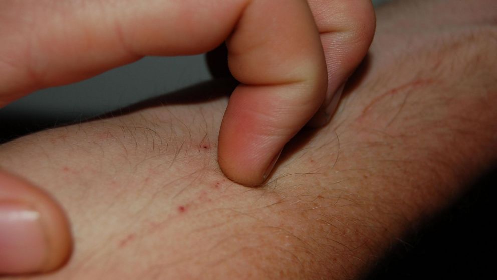 La piel es uno de los órganos más atacados por el coronavirus (Imagen ilustrativa).