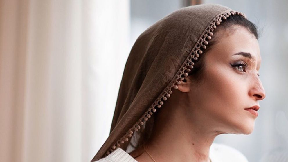 La iraní Marzieh Ebrahimi fue atacada con ácido y lucha para que se haga justicia.