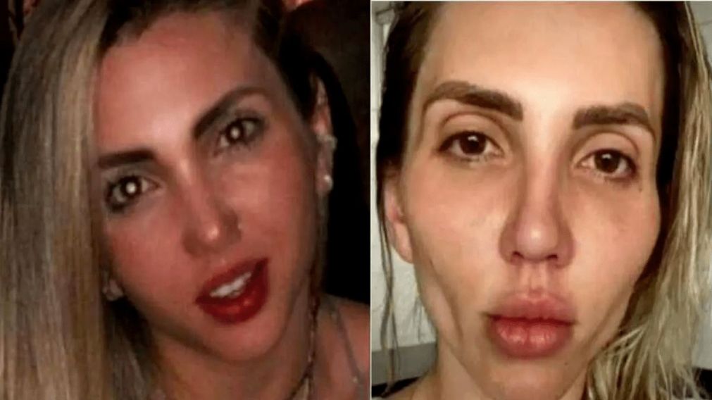 La tiktokter sufrió descolgamiento de piel en su rostro después del tratamiento.