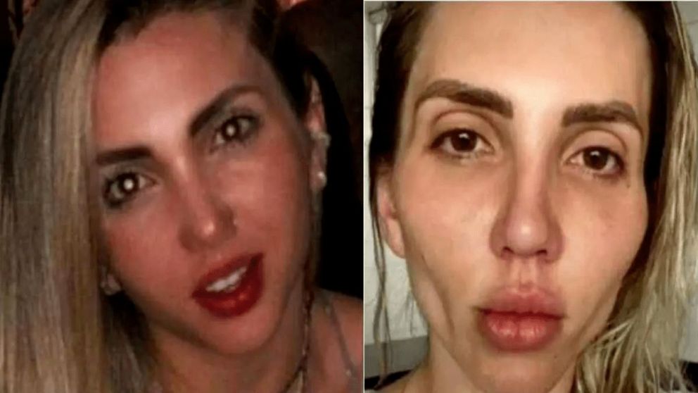 La tiktokter sufrió descolgamiento de piel en su rostro después del tratamiento.