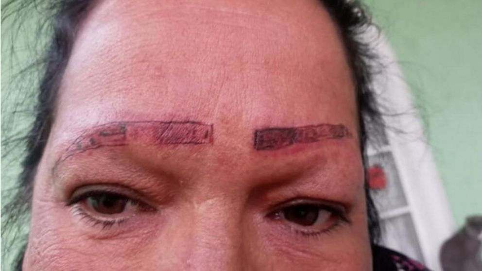 Una mujer se fue a tatuar las cejas y terminó con cicatrices y quemaduras en la cara.