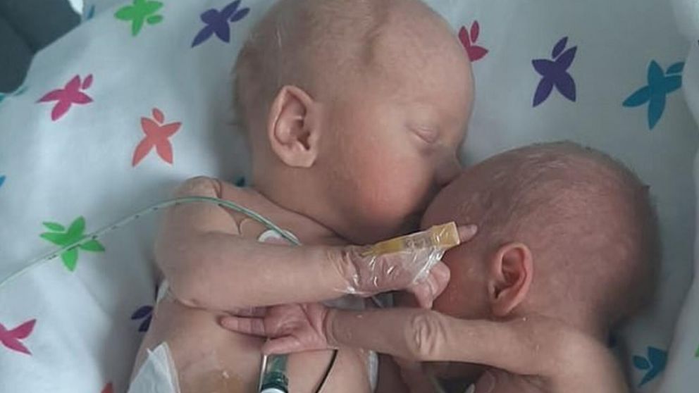 Las bebés Neve y Louie se abrazaron al ser reunidas en la incubadora.