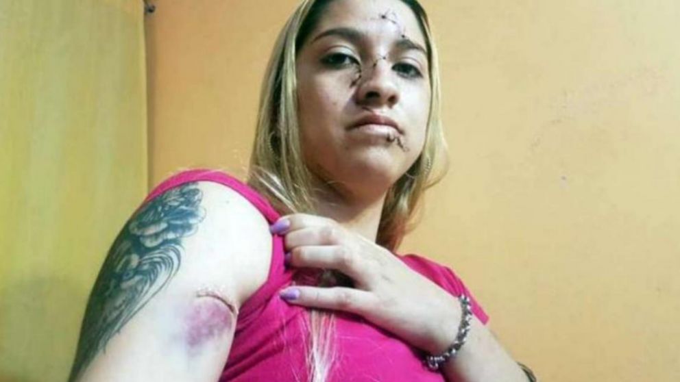 La joven de 19 años tuvo que recibir más de 15 puntos en la cara por la agresión (El Doce)