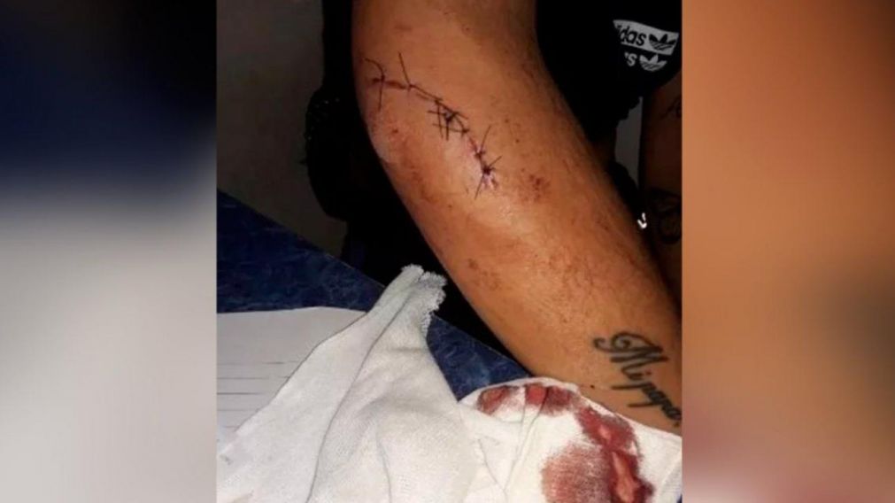 La joven tuvo que ser atendida por los m�dicos a causa de la herida sufrida en el brazo.