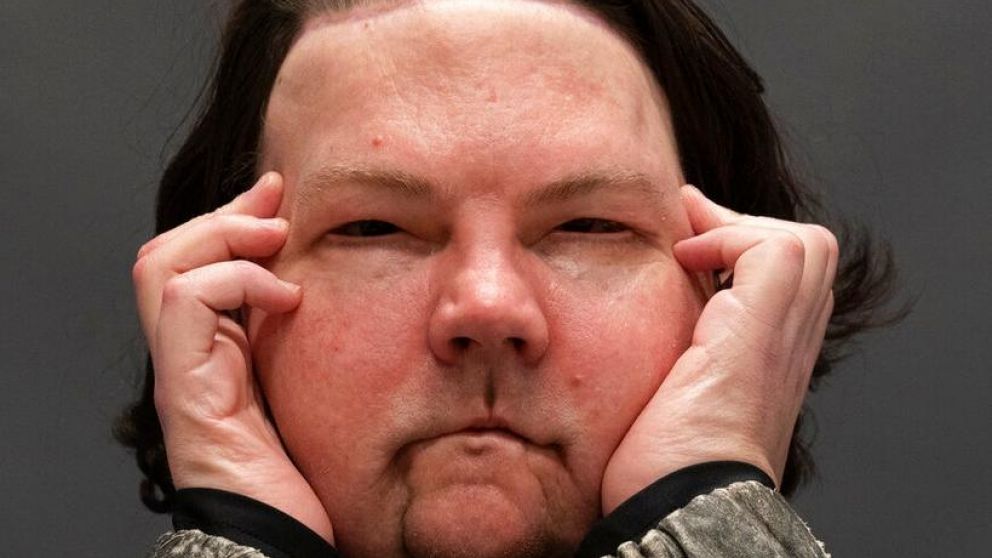 Joe DiMeo, tras la operación