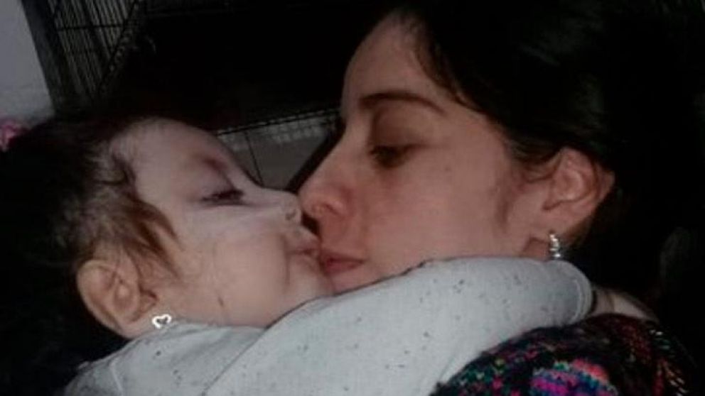 Zoe padecía una enfermedad cerebral llamada hidranencefalia.