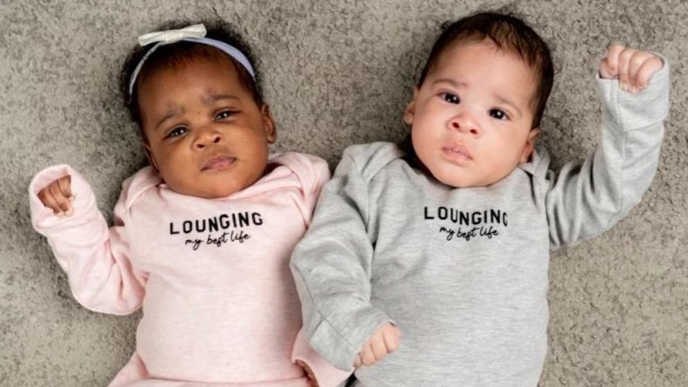 Debido a una particularidad genética, los gemelos nacieron con distinto color de piel (Gentileza The Sun).