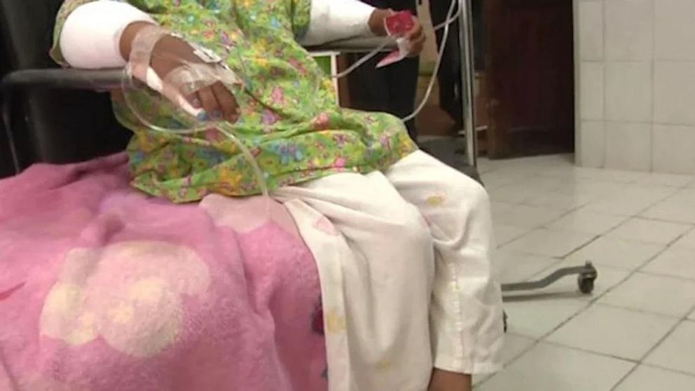 La nena sufrió quemaduras de segundo grado en antebrazos y manos.