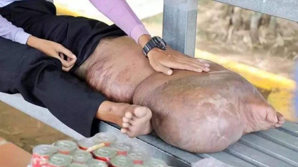 El hombre no pudo ir al m�dico durante 20 a�os por problemas econ�micos