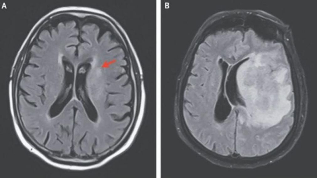 En días, el encefalograma cambió de manera rotunda (The New England Journal of Medicine).