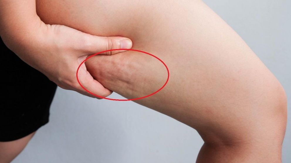 Investigan la muerte de una mujer durante sesión para eliminar la celulitis. (Imagen ilustrativa)