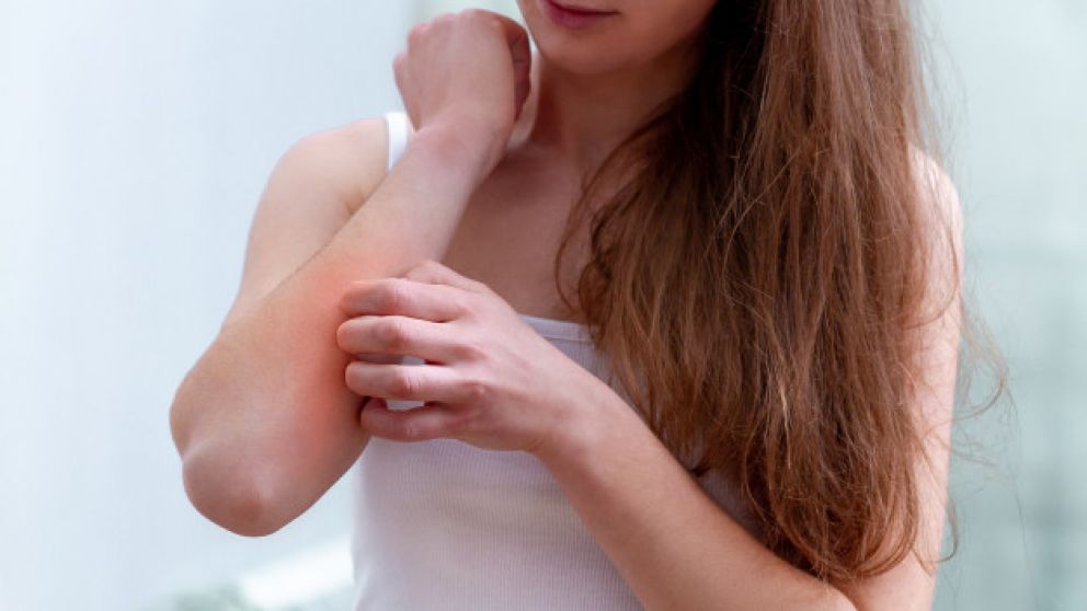 La Dermatitis Atópica (DA) es una enfermedad crónica e inflamatoria de la piel.