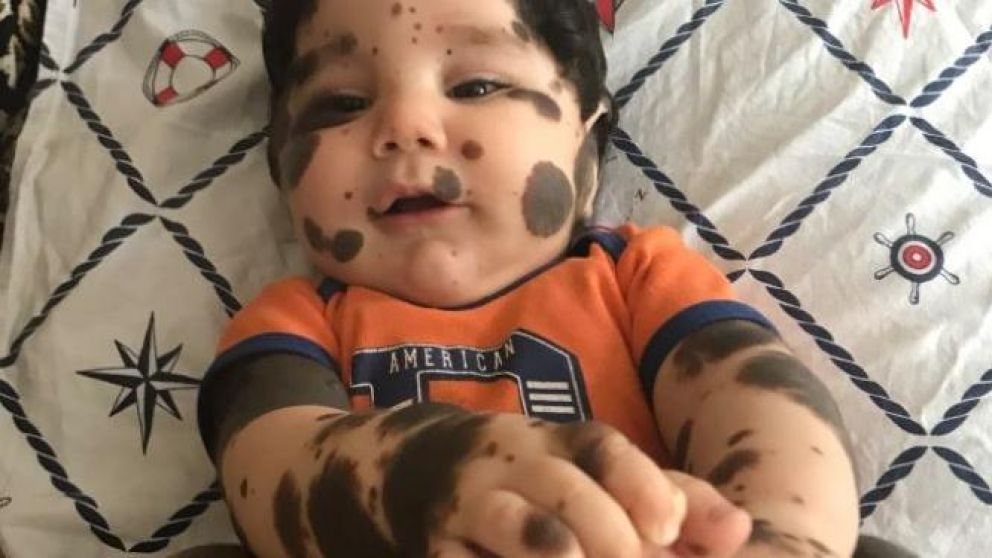 El bebé nació con manchas en el 80 por ciento de su cuerpo.