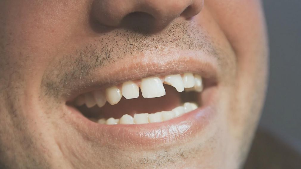 Especialista afirma que los dientes rotos son producto de la pandemia de coronavirus. (Foto ilustrativa)