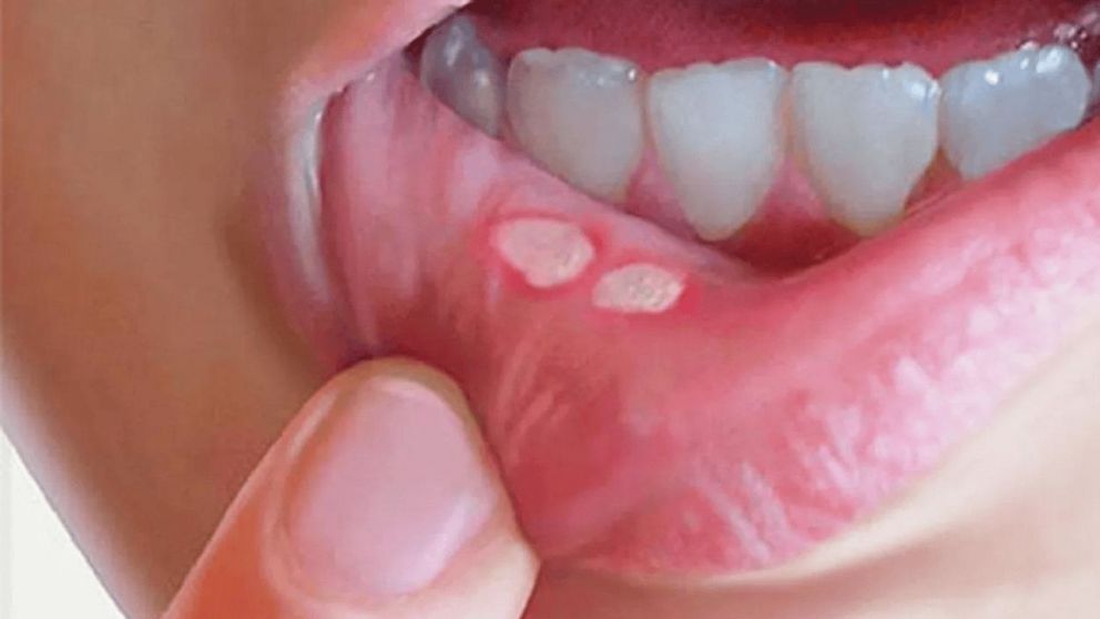 En las primeras 44 semanas de 2025 se acumularon 36.702 contagios de sífilis.