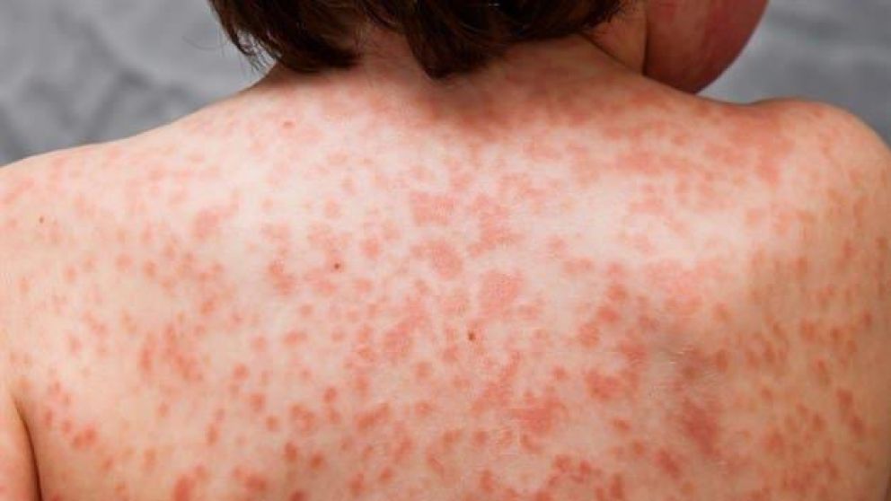 La enfermedad consiste en una dilatación de los vasos sanguíneos (Imagen ilustrativa).