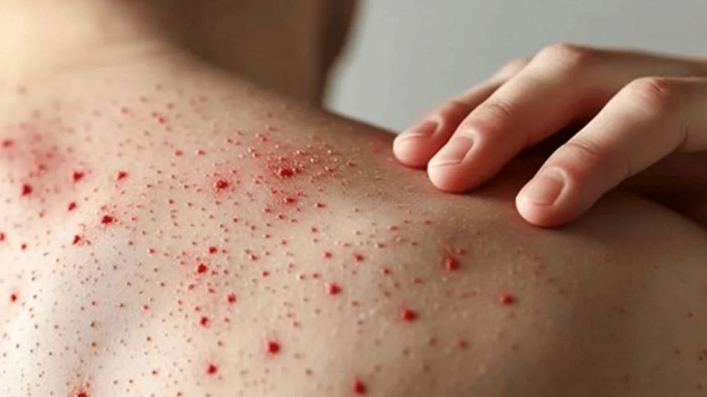 El Ministerio de Salud comenz� a distribuir la vacuna contra el sarampi�n
