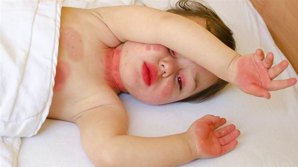 La enfermedad de Kawasaki puede provocar el engrosamiento de las glándulas linfáticas bajo la mandíbula.