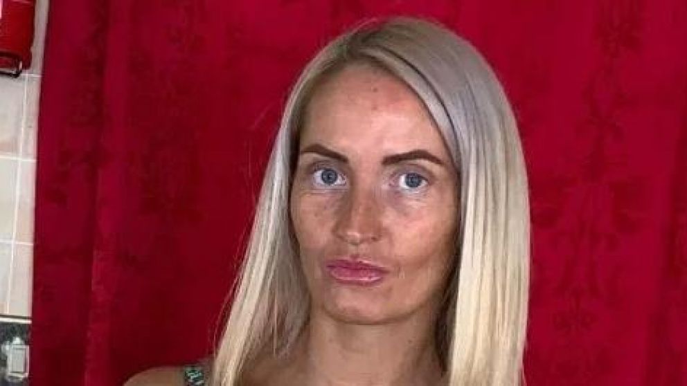 La mujer de 35 años utilizó un bronceador vencido durante más tiempo del indicado y sufrió la decoloración de su piel.